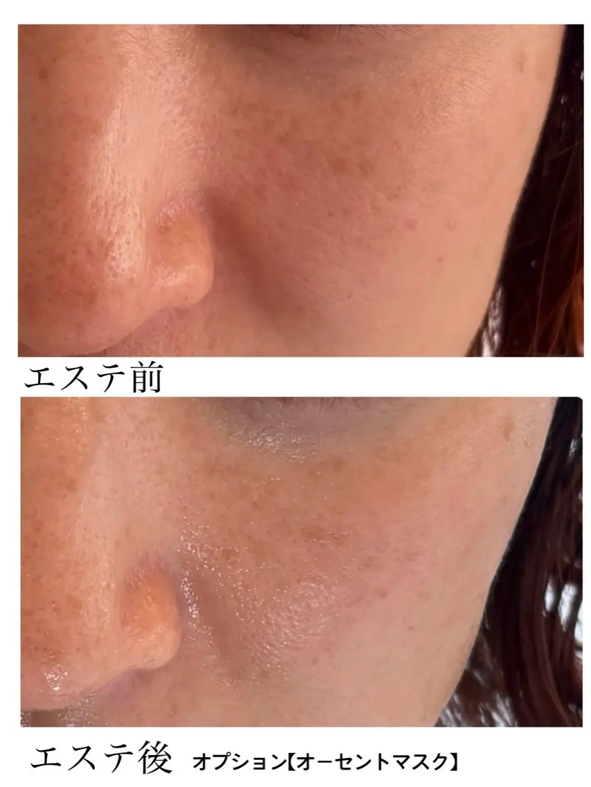ミニモ限定！今だけ！【小顔へ、リンパを流す】フェイシャルエステ/エイジングケア＋無料鼻パックの写真