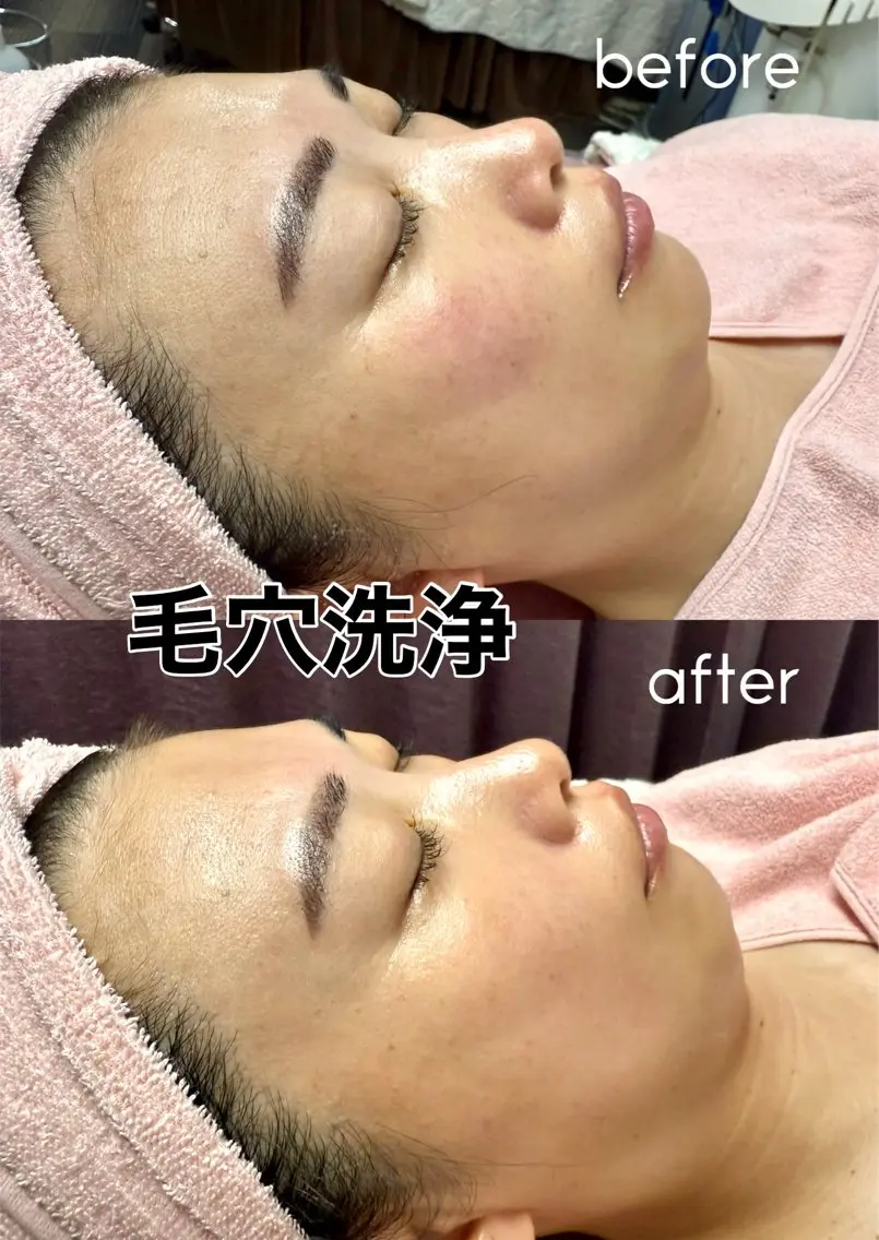 “毛穴どこいった?!”と驚かれる透明肌へ💫毛穴集中洗浄フェイシャル【平日限定】の写真