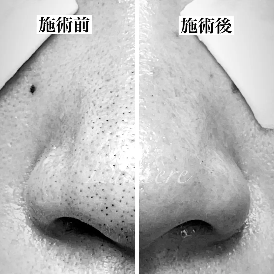 【黒ずみ毛穴大掃除👃✨】初回限定エクストラクション×その場で作る生パック付き 看護師施術で安心安全 南森町駅徒歩5分の写真