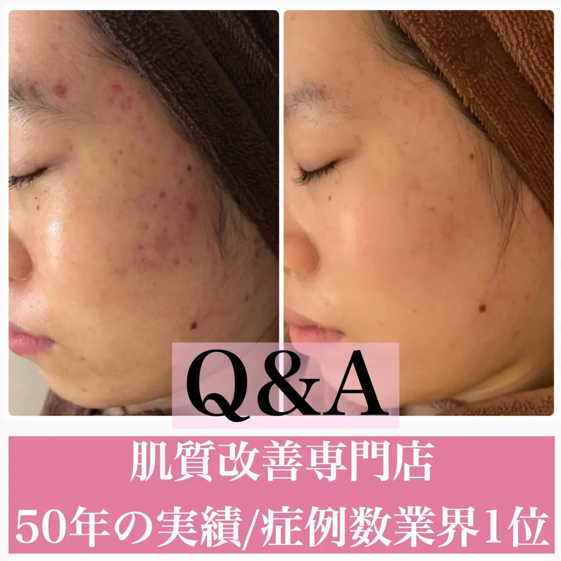 ミディアム カラー パーマ ヘアアレンジ メンズ キッズ ネイル マツエク・マツパ 学生(メンズ向け) 学生 エステ リラク ニキビ・肌質改善専門 ♡人生が変わるサロンのエステ・リラクイメージ
