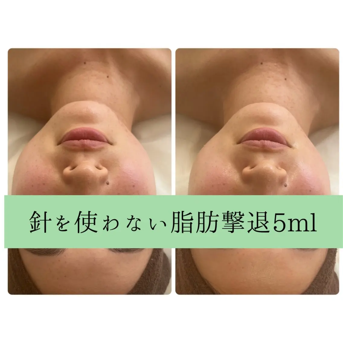 🌸新生活応援🌸残5名様💠針を使わない脂肪撃退&ハイパーナイフEX🙆♀️お顔5mlの写真