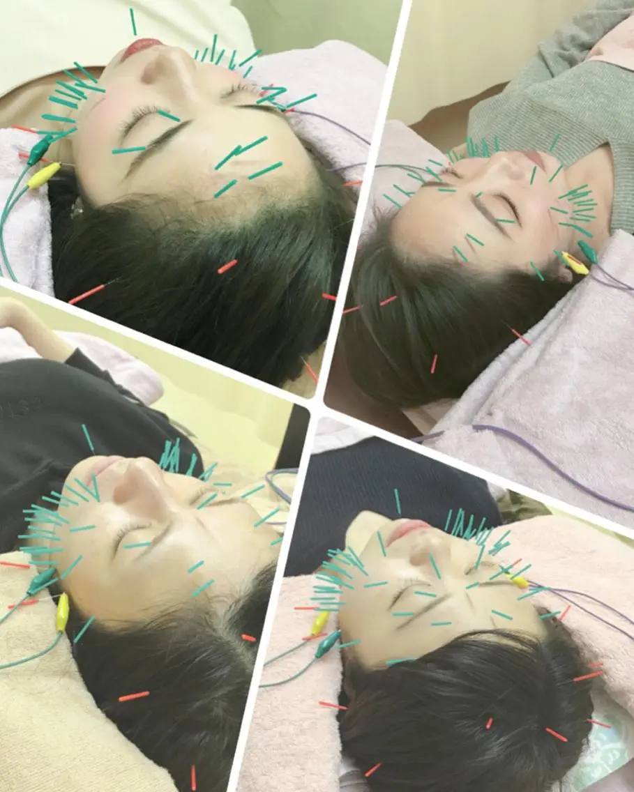 ✨サブスク美容鍼✨先着5名様まで☝️4回で一万円のコースになります😊短期間でお肌のお悩みを解決したい方にぜひどうぞ❤️の写真