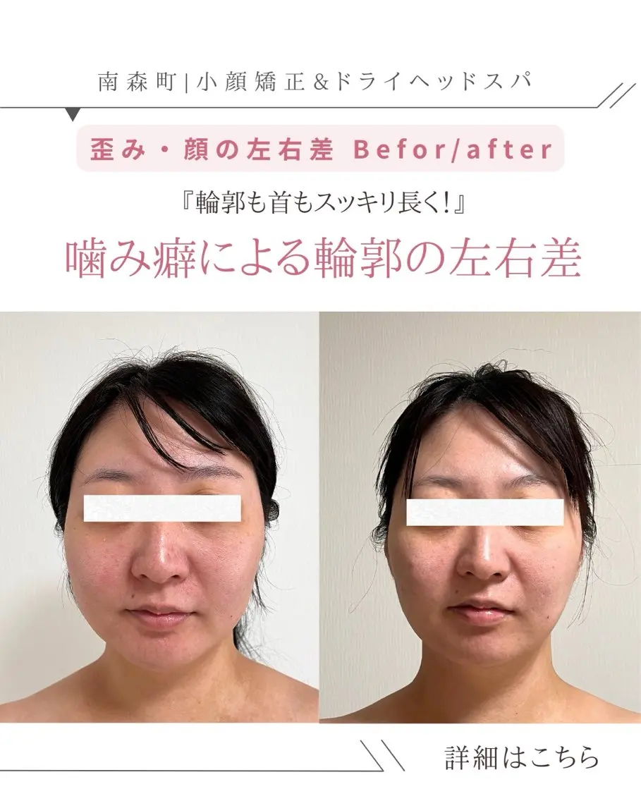 🌿 30代限定 3ヶ月間(6回来店条件)90分【エラ張り/食いしばり解消小顔ヘッドスパ】の写真