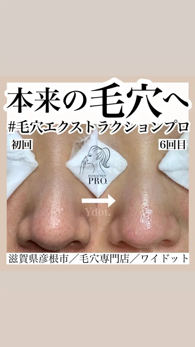 毛穴スッキリ美肌コースの写真