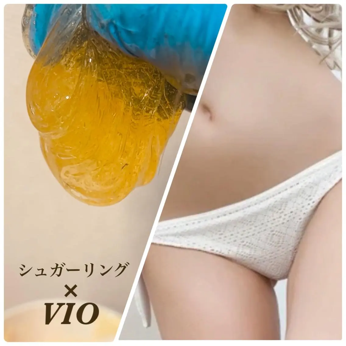 【ご新規様&1ヶ月以内】VIO シュガーリング脱毛🐝の写真