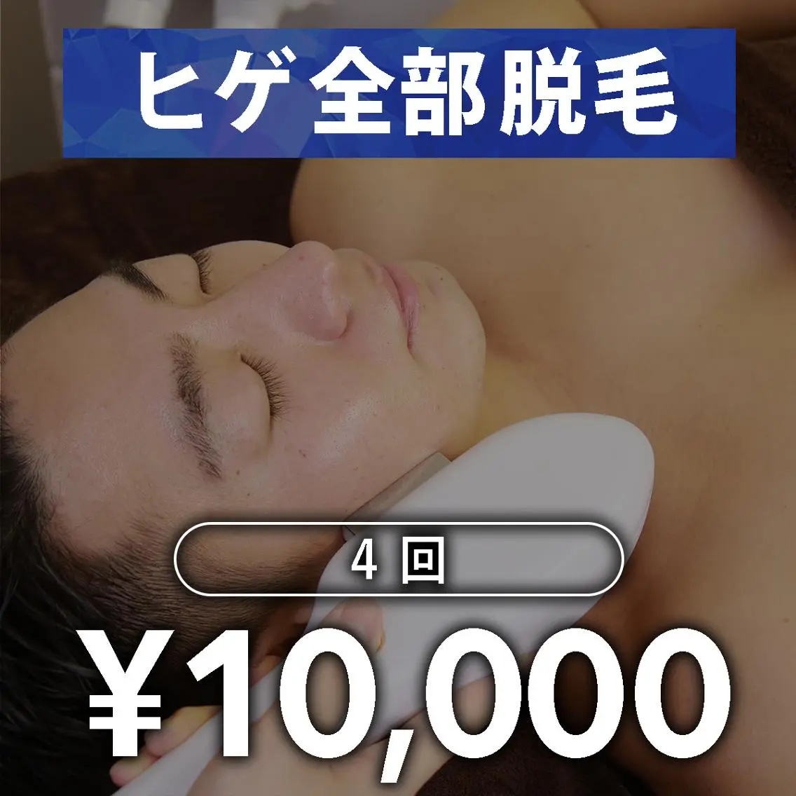 【メンズ脱毛】ヒゲ脱毛 4回の写真