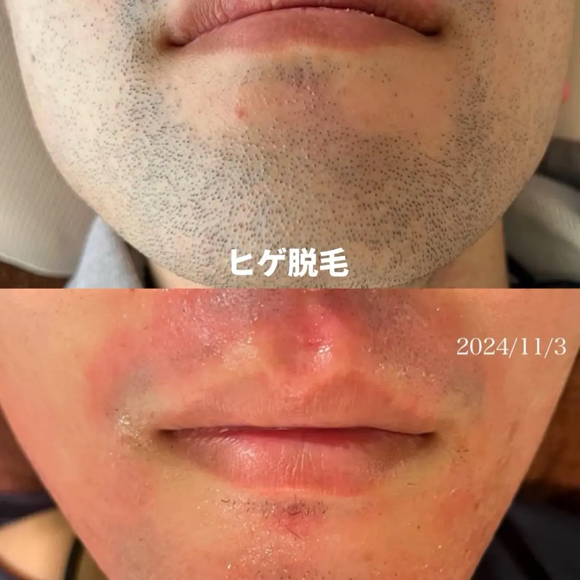 ヒゲ脱毛の写真