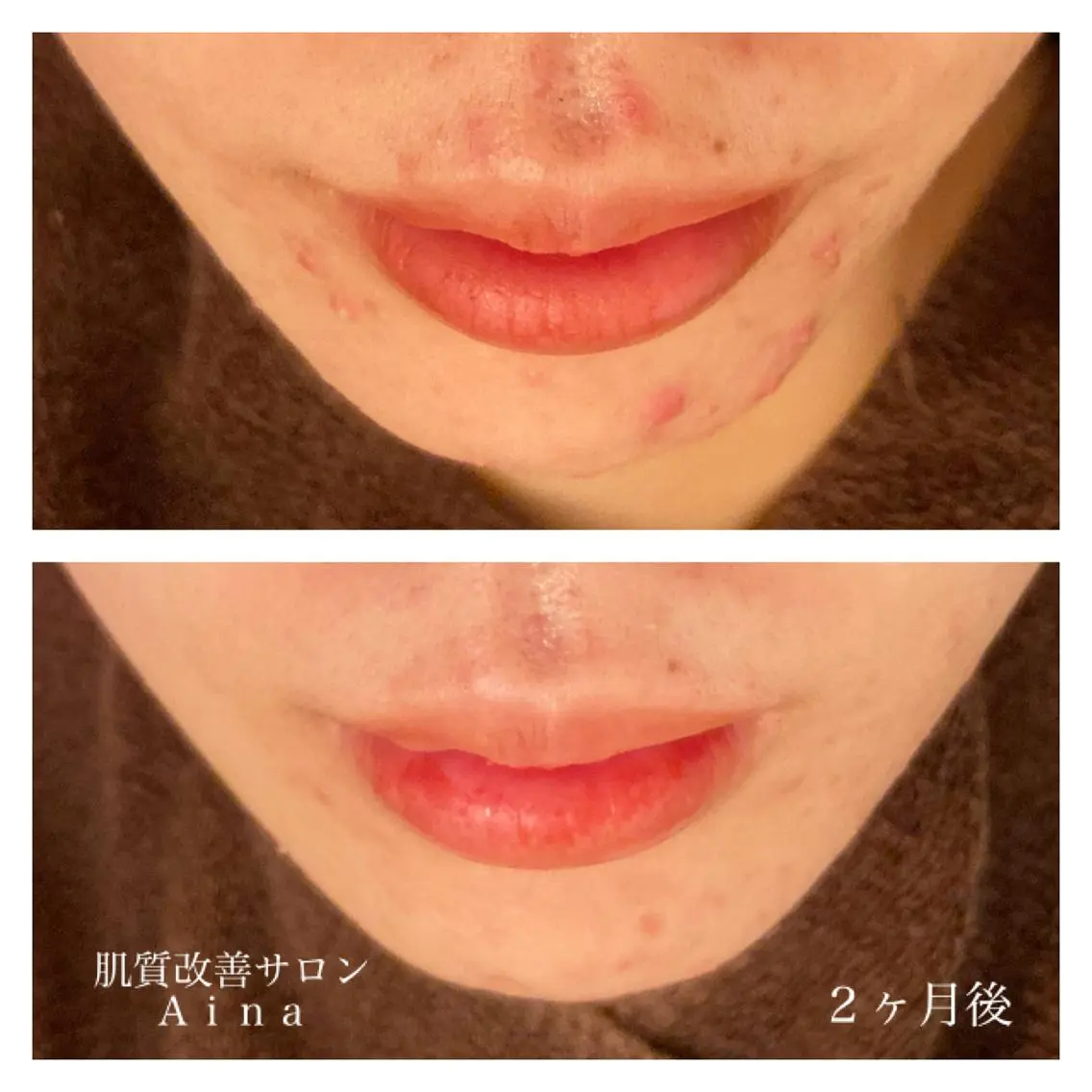 セミロング カラー パーマ ヘアアレンジ メンズ キッズ ネイル マツエク・マツパ ニキビ跡専門サロン Ａｉｎａのエステ・リラクイメージ