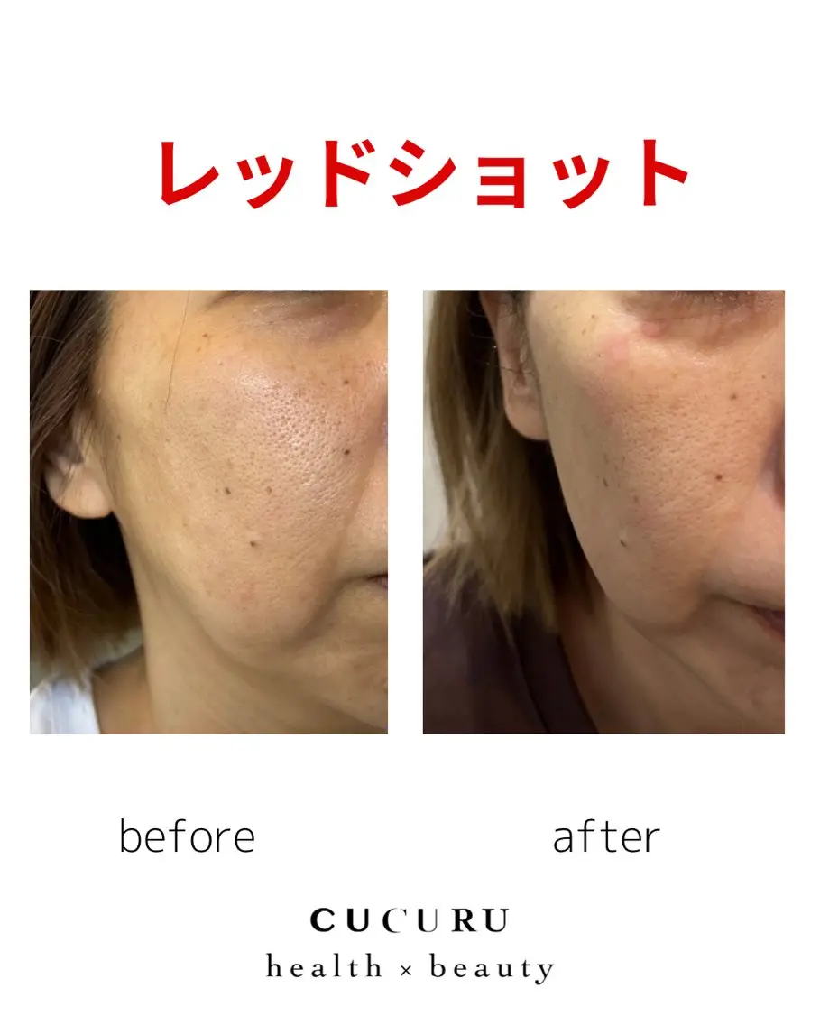 切らずに小顔レッドショット！気になる二重アゴ、フェイスラインをスッキリ小顔へ✨プラズマ導入で乾燥、ニキビも一緒にケアの写真