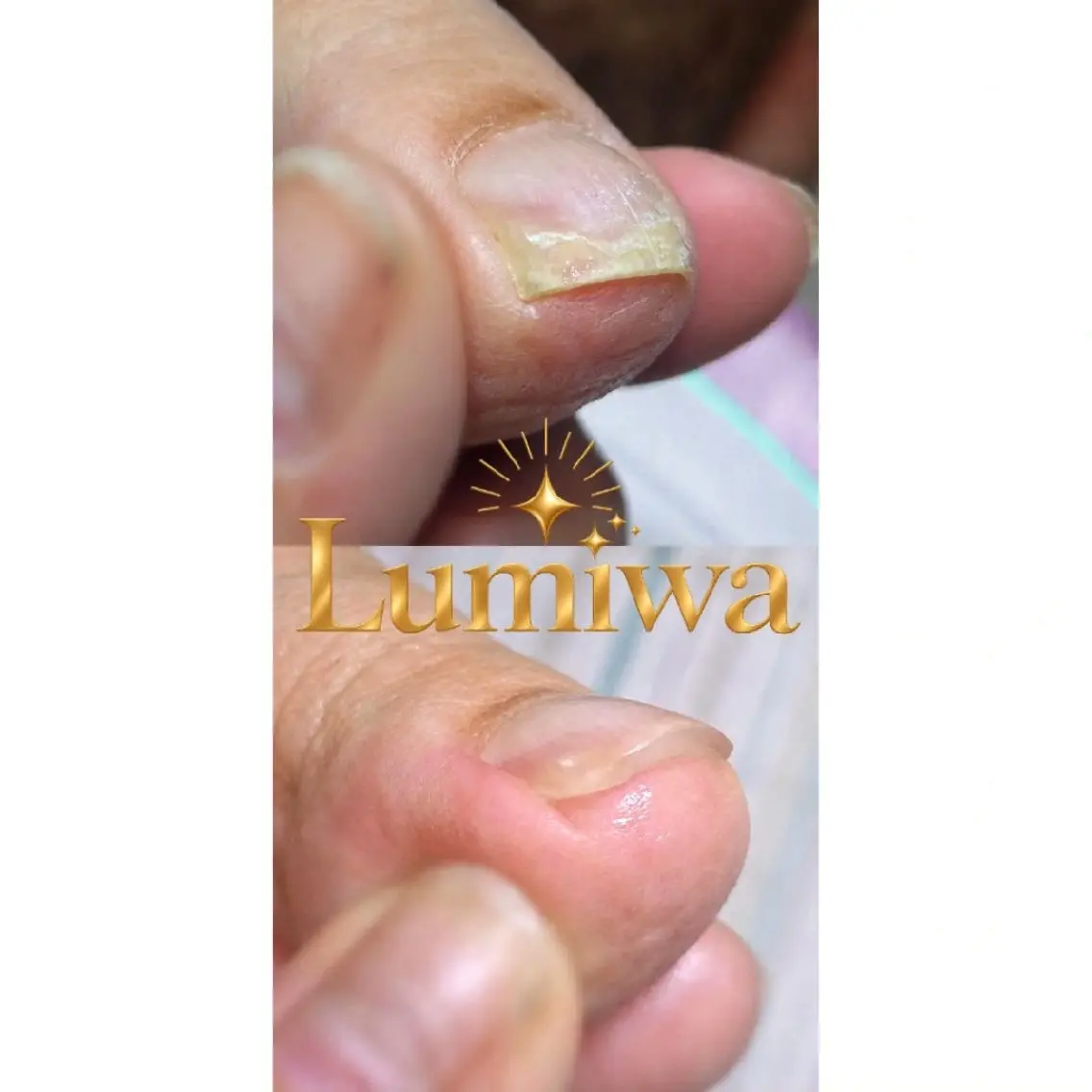 あとお一人です☆【練習モデル】巻き爪補正|親指1本の写真