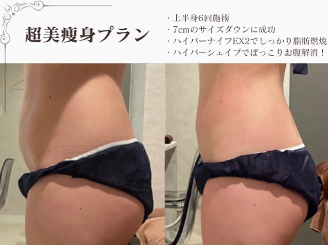 【人気No.5】骨盤矯正付き全身撤退痩身|進化型最新ハイパーナイフEX2+ハイパーシェイプ+強圧リンパの写真