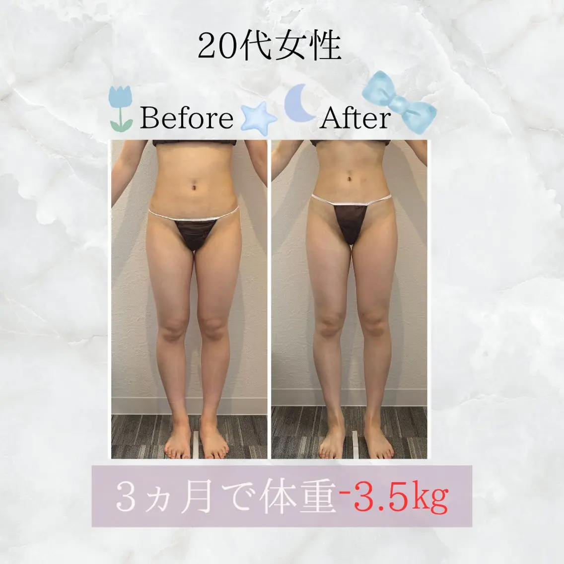 【痩身/下半身】ハイパーナイフ60分の写真