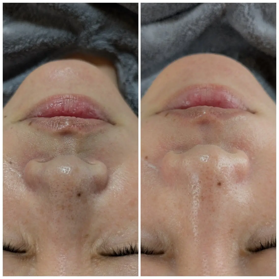 超音波小顔ソニック×水光肌WAX(部分WAXお好きな箇所１カ所のみ)の写真