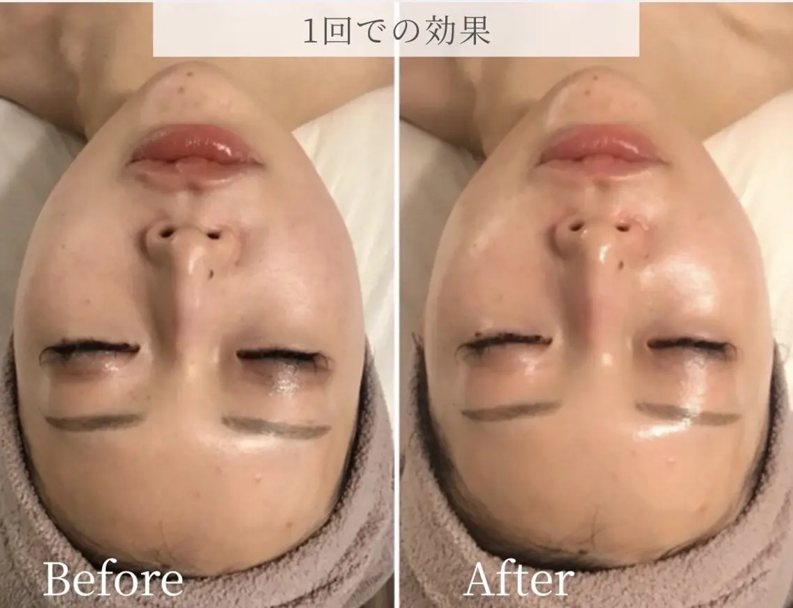 ミニモ限定価格!【憧れのツヤ肌へ✨】毛穴・ニキビ・くすみ・乾燥・シワケアなどのお悩みにアプローチ!の写真