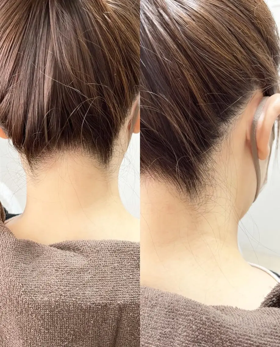 \ 女性専用menu /  うなじ脱毛の写真