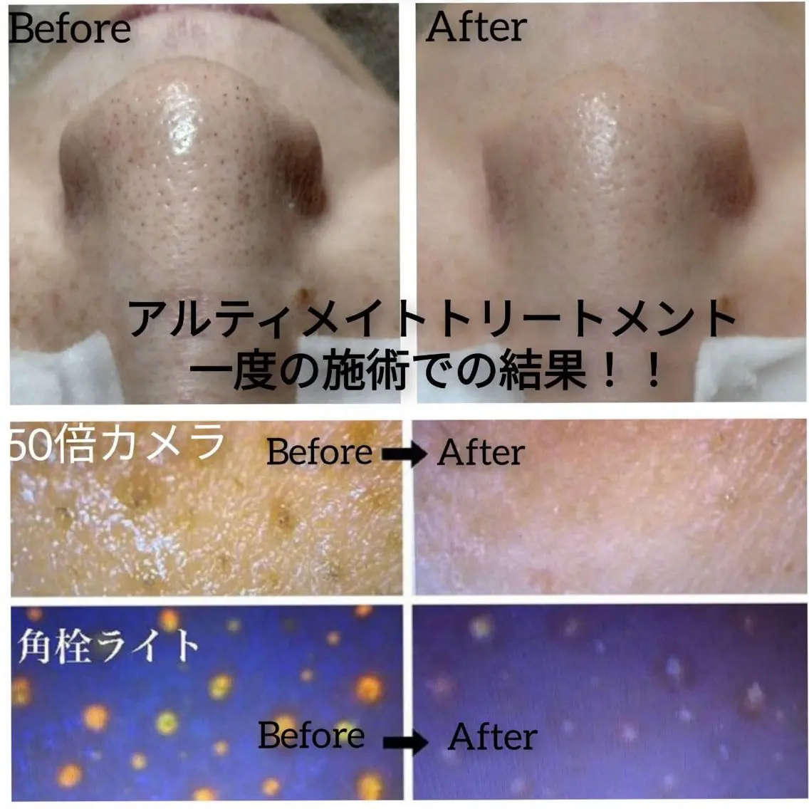 頑固な黒ずみ撃退‼️徹底毛穴洗浄毛穴レスアルティメイトコース🌟黒ずみ ニキビ ニキビ跡 毛穴縮小⭕️全顔水素吸引付‼️の写真