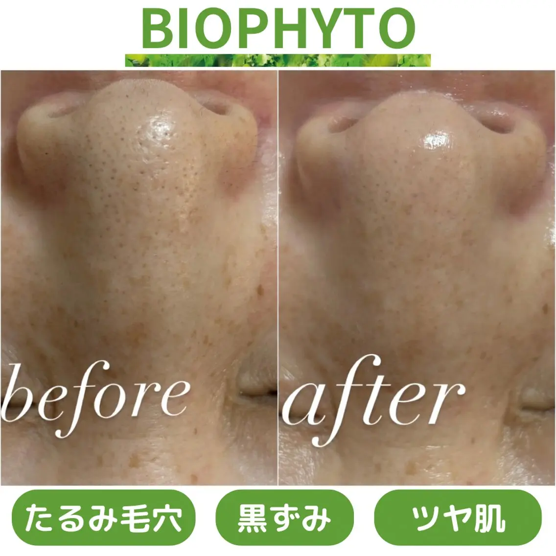 💚毛穴ケア(黒ずみ/開き/皮脂)ニキビケアに🌿肌活力UPハーブピーリング|クリスティーナ“ビオフィート”60分の写真