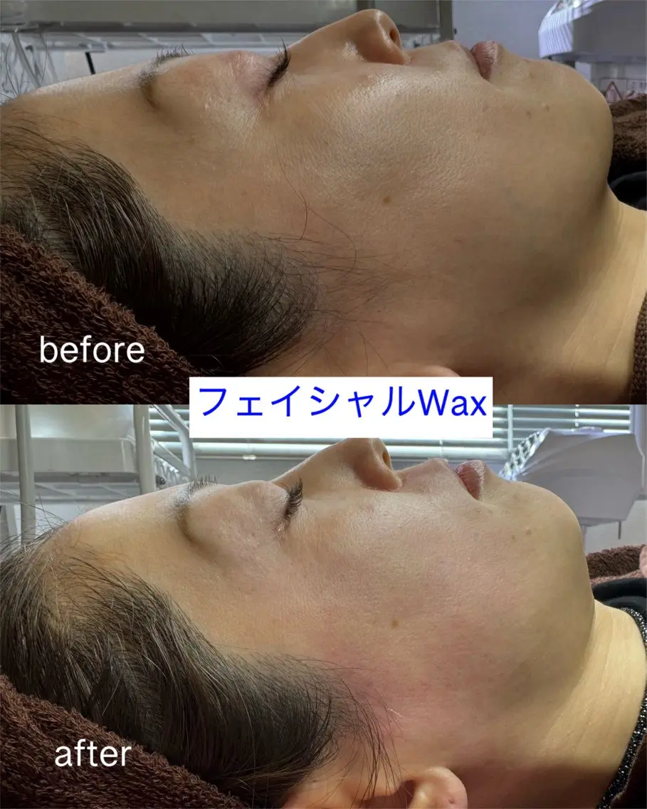 ミニモ限定😍お顔の産毛＆ダニ・角質除去◎【スキンケアワックス脱毛＋プルプルパック付】全顔通常9,800→5800円！の写真