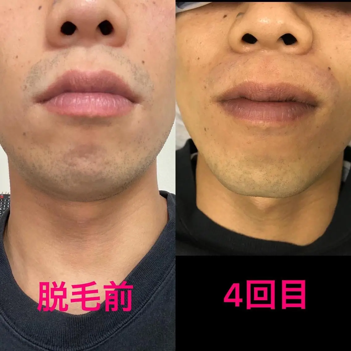 メンズ 脱毛 メンズ脱毛サロン /金山昌弘のエステ・リラクイメージ