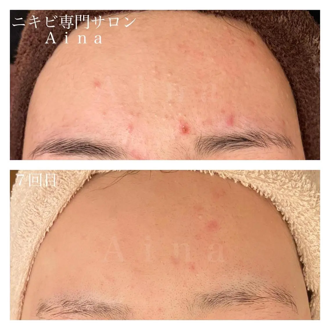 セミロング パーマ ヘアアレンジ メンズ キッズ ネイル マツエク・マツパ エステ リラク ニキビ跡専門サロン Ainaのエステ・リラクイメージ