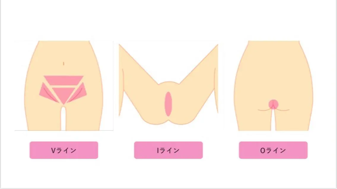 ＶＩＯ脱毛 1回分(カウンセリング込み)🧖‍♀️の写真