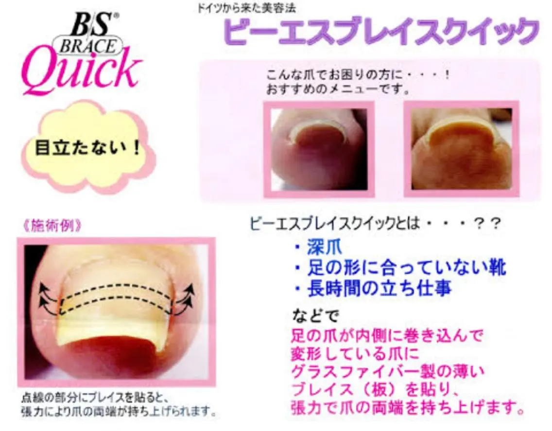B/Sブレイスクイック1本（巻き爪の緩和）の写真