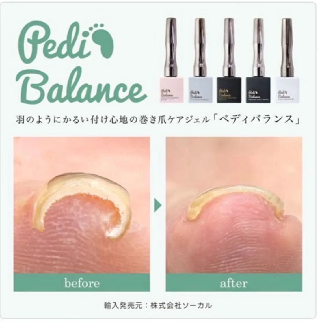 【最先端巻き爪ケア】ジェルを楽しみながら巻爪ケアできます❣️ペディバランス🐾の写真