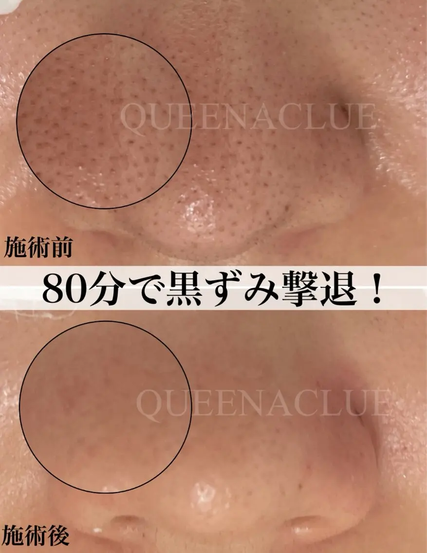 お肌トータルケア【毛穴改善ケア&小顔フェイシャル&ヘッドマッサージ&アロマオイルで首肩背中腕ほぐし】¥13000の写真