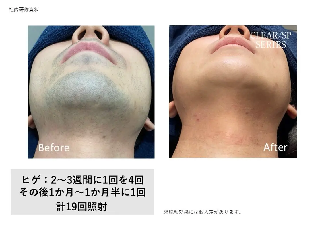 顔　部分脱毛の写真