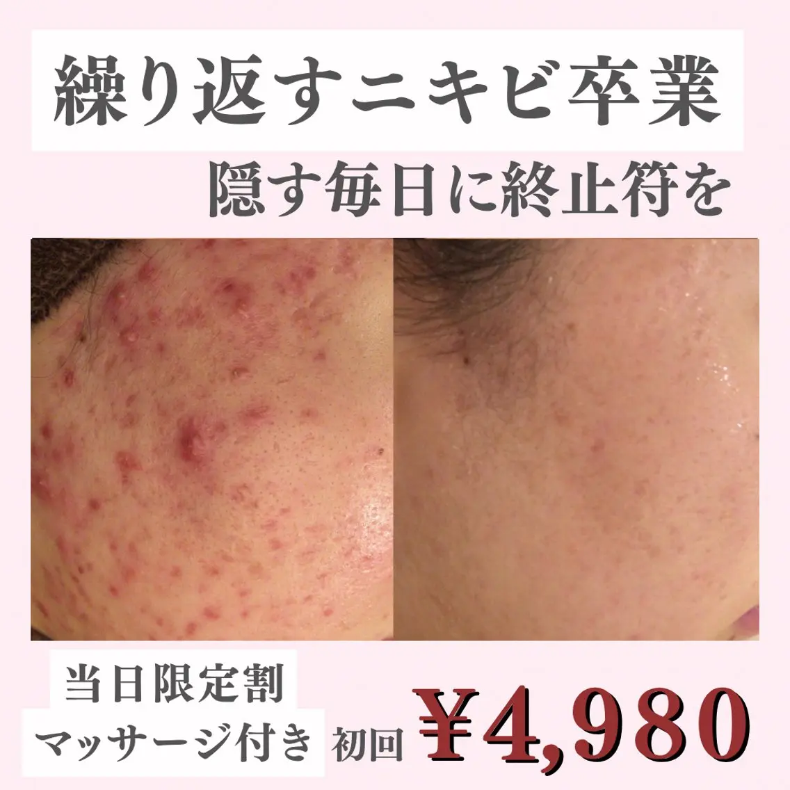 【本日限定】隠す毎日を終わらせたい方へ|ニキビ跡・凹凸肌専用ケア ¥4,980(ヘッドマッサージ付)の写真