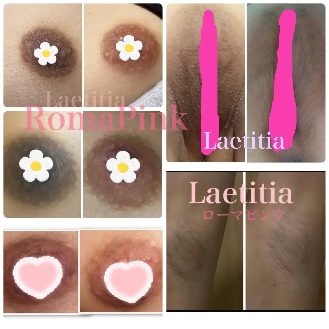 【6月末まで特別キャンペーン価格✨】ローマピンク🌸『ニップル＆Iライン』の写真