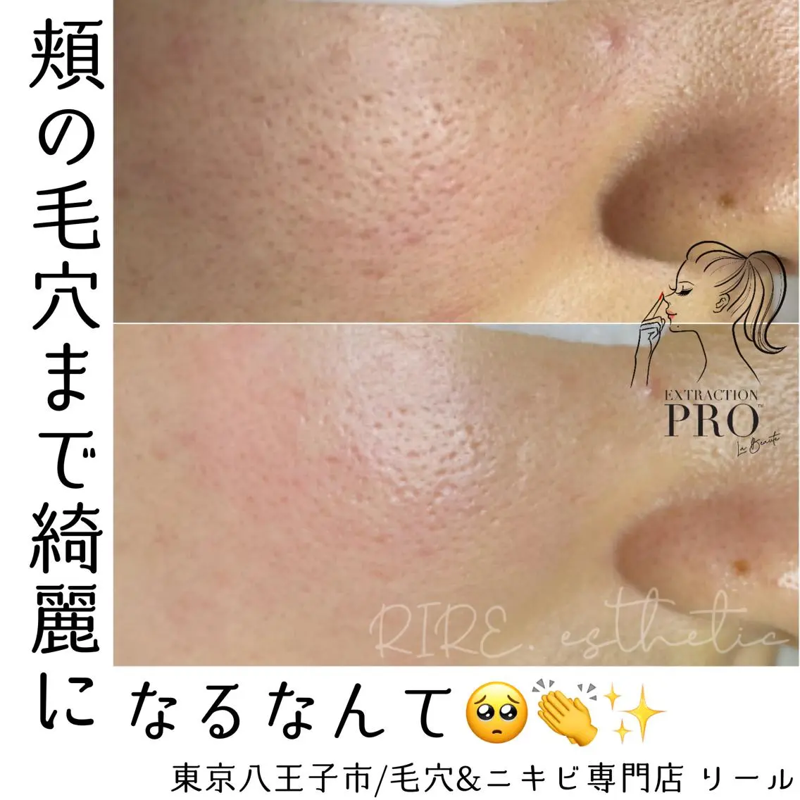 毛穴特化エステ -リールのエステ・リラクイメージ