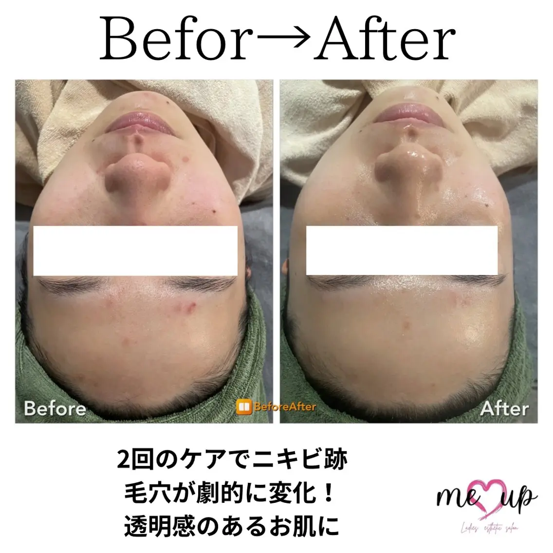 エステ Meupニキビ専門店 背中/ハーブ/肌管理のその他イメージ