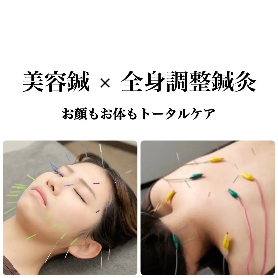 【期間限定キャンペーン】人気No.1!贅沢全身鍼灸(90分)の写真