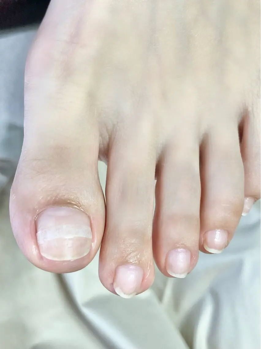 5名様限定✨巻き爪ケアモニター(ケア＋チップ装着)親指1本の写真