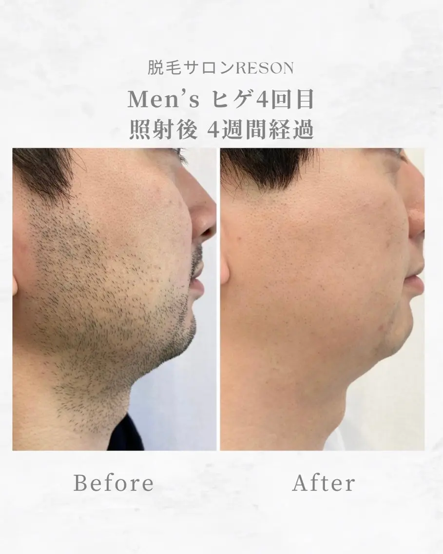 メンズ ヒゲ脱毛の写真