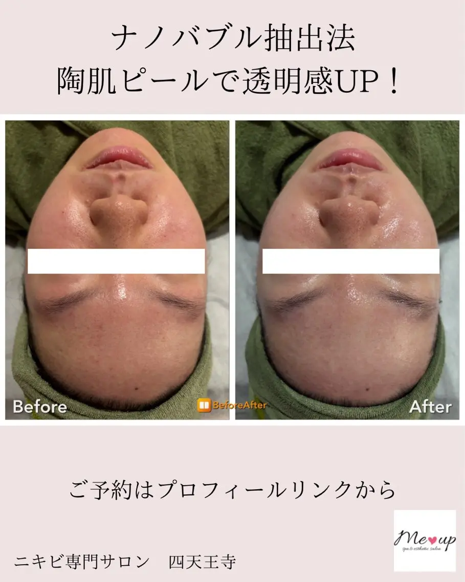 エステ Meupニキビ専門店 背中/ハーブ/肌管理のその他イメージ