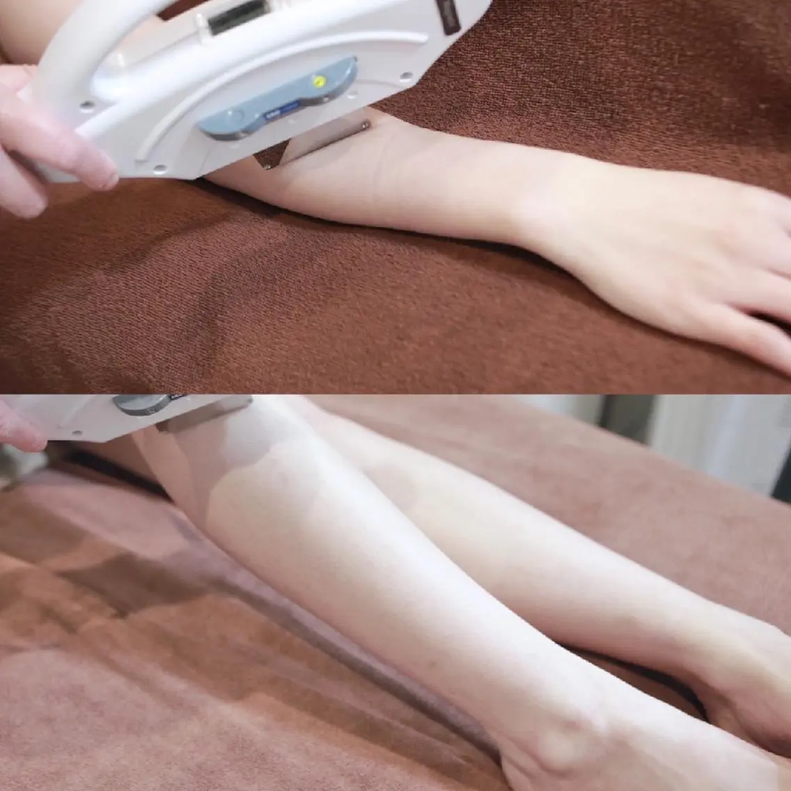 【新規】レディース両腕（ワキ込）or両脚脱毛の写真