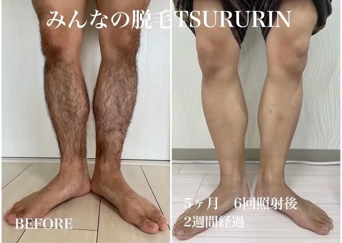 初回限定🌟男性脚or腕セット脱毛👨通常¥10,000→¥5,000‼️（肘上下•手甲指）or（膝上下•足甲指）の写真