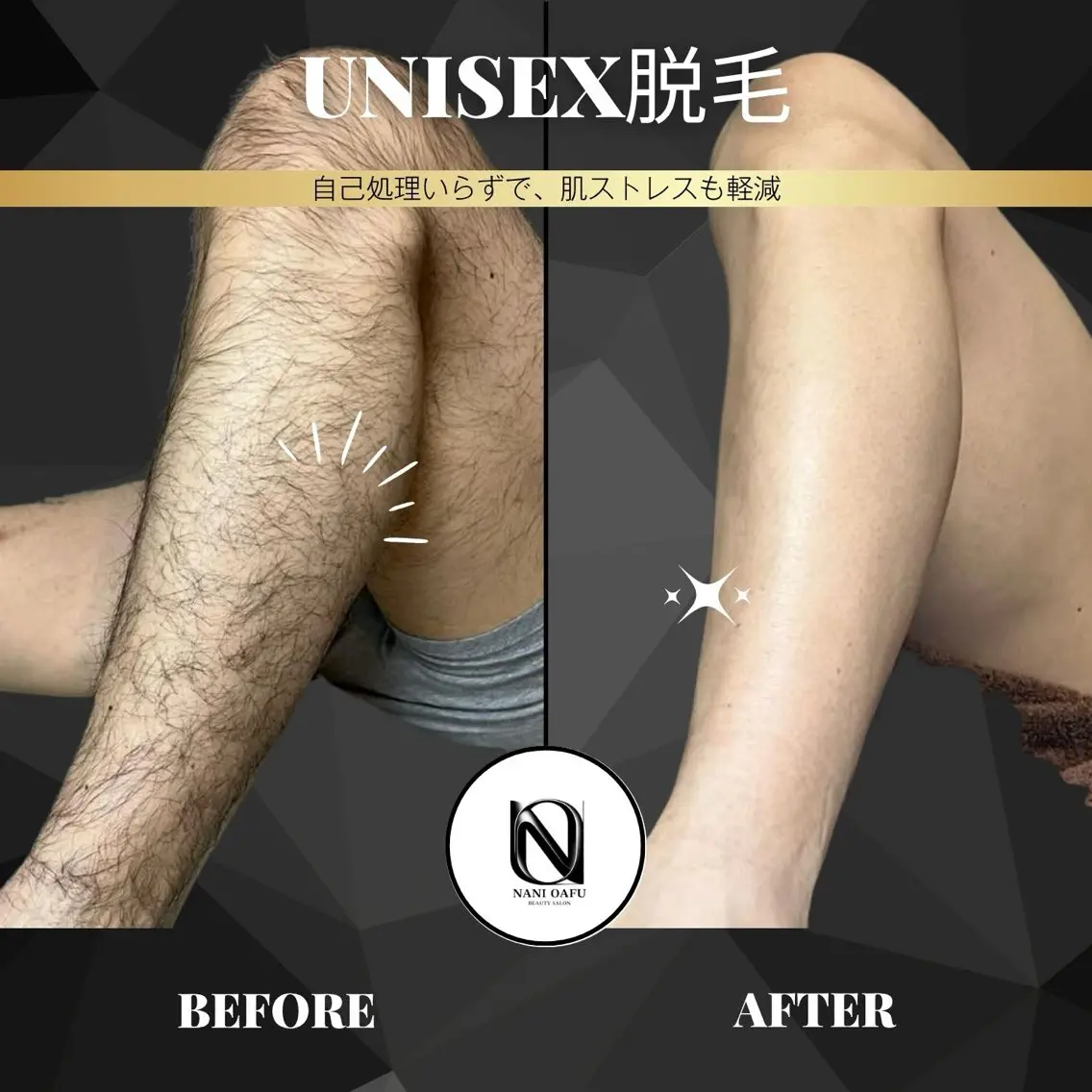 【UNISEX脱毛🫧】	N-AHR方式使用 –抜け感×美肌を同時に叶える、新時代のスピード脱毛 –の写真