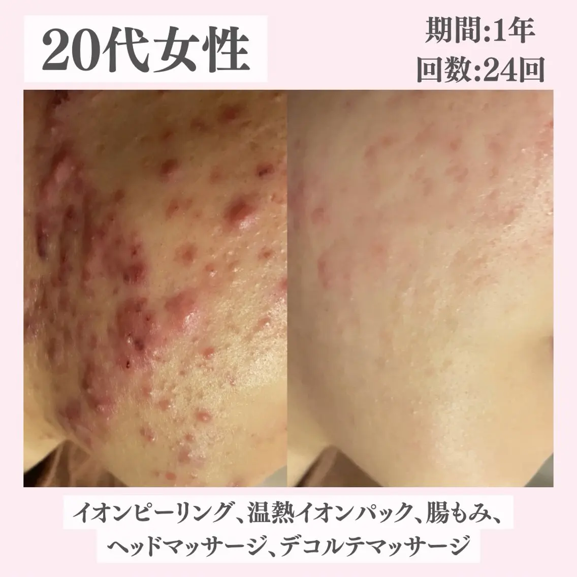 エステ リラク ニキビ・肌質改善専門 ♡人生が変わるサロンのエステ・リラクイメージ