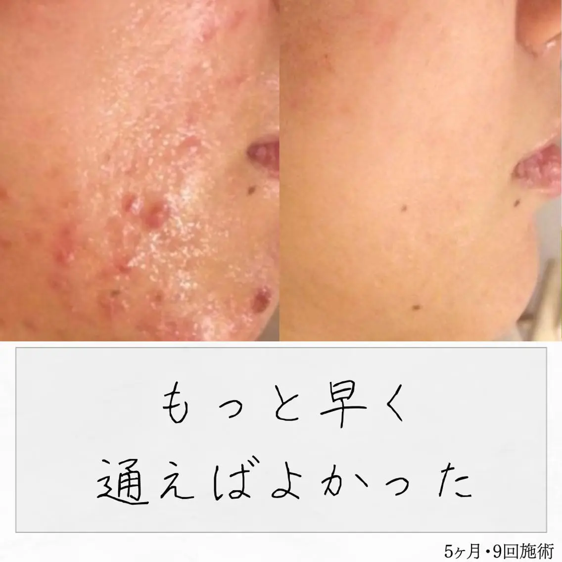 ニキビ経験者が施術 する専門サロン🌻のエステ・リラクイメージ
