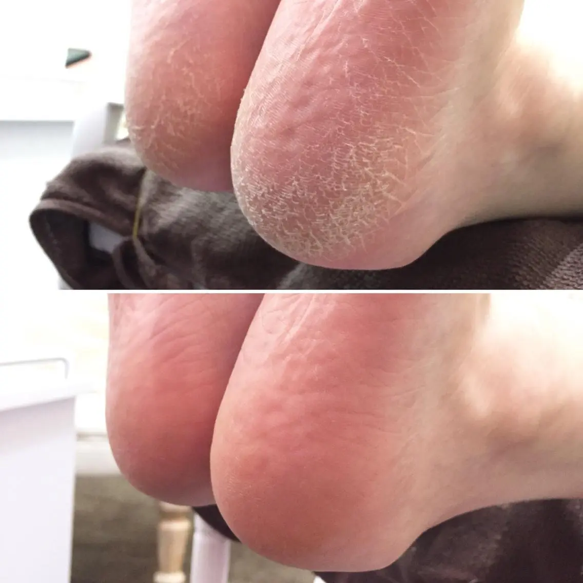 【かかと角質ケア】驚くほど取れますよ!保湿しながら角質を取るのでつるつる・モチモチの仕上がり😊の写真