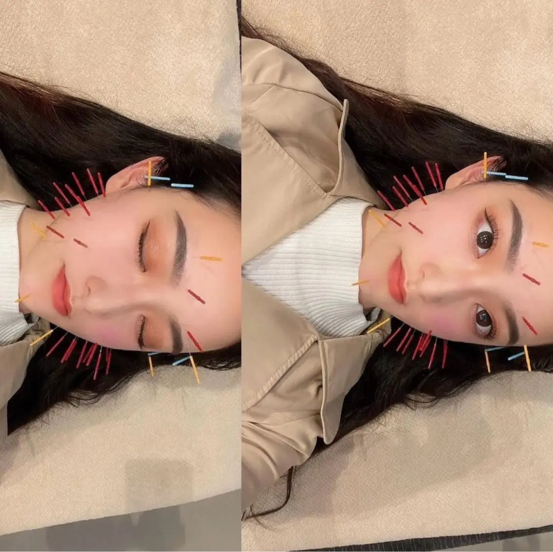 月曜・水曜限定🌱【小顔美容鍼】起きたときのむくみ、寝ている時の食いしばりが気になる方におすすめの写真