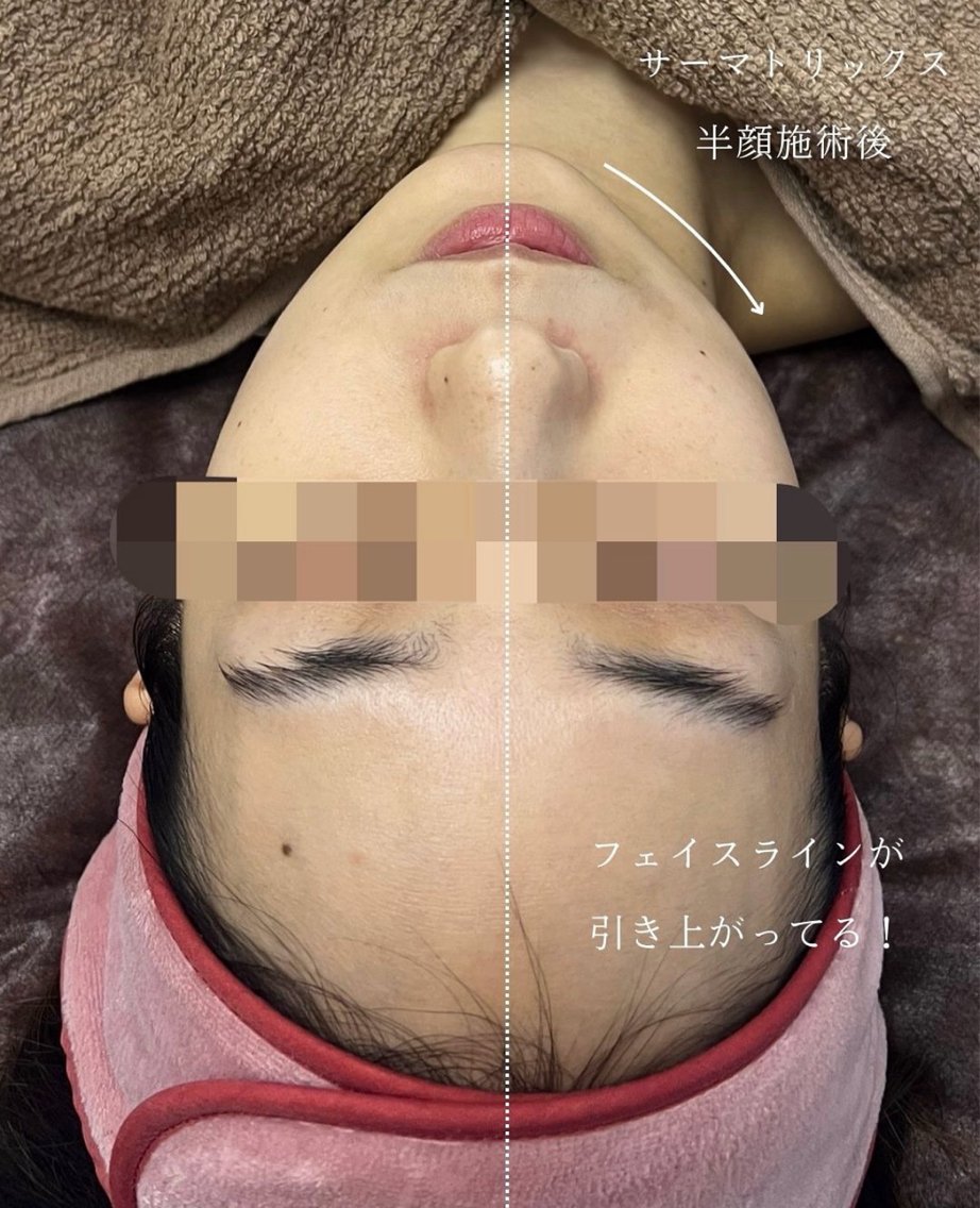 【全体的にスッキリさせたい方】高周波引き締めケア（顔＋顎下＋首）＋水光パックの写真