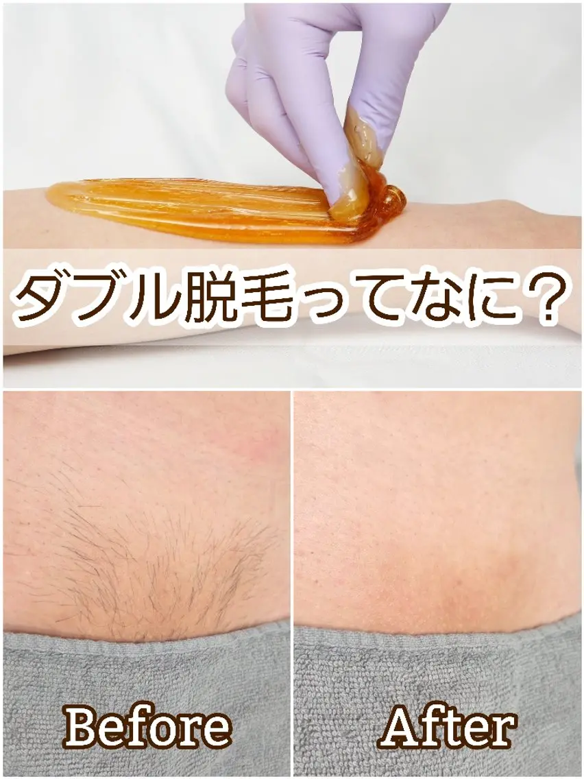 脱毛 A*《エースター》 シュガーリング🍋のエステ・リラクイメージ