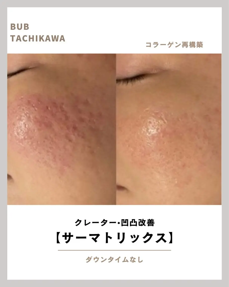 【ニキビ跡・クレーターに特化】サーマトリックス頬集中照射+鎮静パック|凸凹肌を均一に整えるの写真