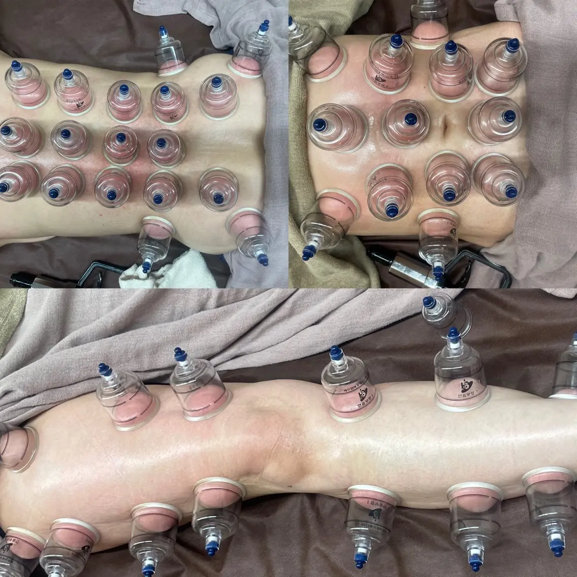 【身体スッキリ】 カッピング&スライドカッピング 上半身or下半身の写真