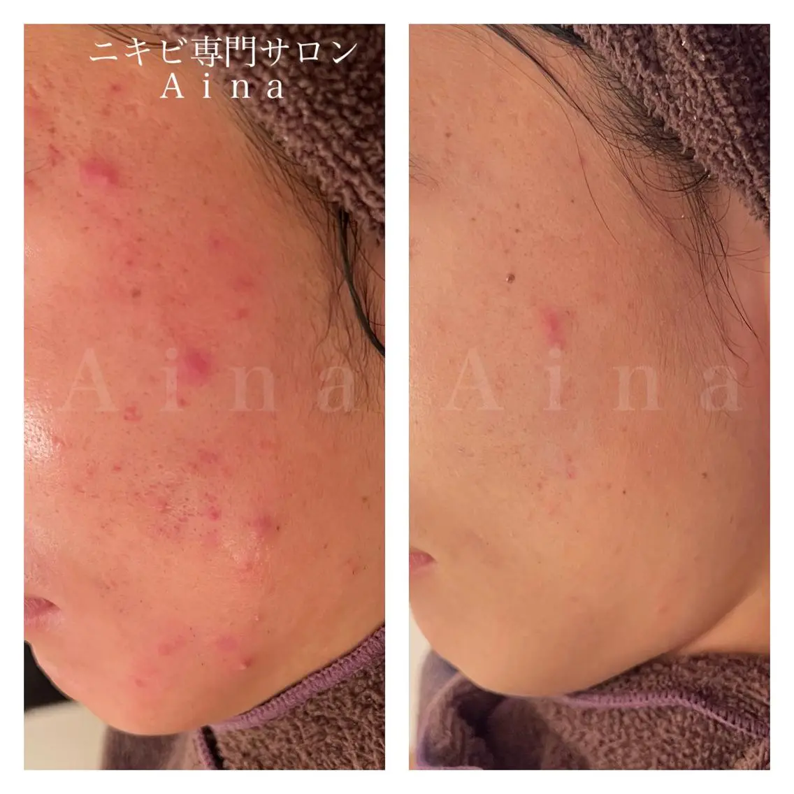 セミロング ヘアアレンジ メンズ キッズ ネイル アイブロウ 赤色 エステ リラク ニキビ跡専門サロン Ainaのエステ・リラクイメージ