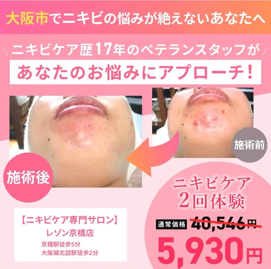 《人気No.1》リピート率90％以上！本気のニキビ対策！ニキビ跡にも◎ニキビケア/フェイシャル２回体験の写真